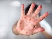 Argentina: Se confirma primer caso de viruela del mono