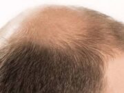 Estados Unidos aprobó la primera píldora para el tratamiento de la alopecia