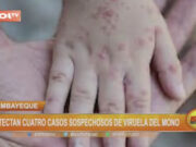 Lambayeque: detectan cuatro casos sospechosos de viruela del mono