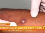 Lambayeque: confirman tres casos de la Viruela del Mono en la región