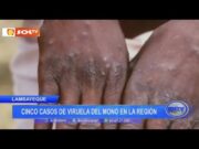 Lambayeque: cinco casos de viruela del mono en la región