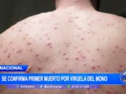 Perú: viruela del mono cobra una vida