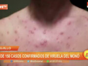 Trujillo: más de 150 casos confirmados de viruela del mono