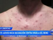 La Libertad: este jueves inicia vacunación contra viruela del mono