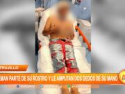 Trujillo: Queman parte de su rostro y le amputan dos dedos de su mano