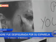 Chiclayo: madre fue desfigurada por su expareja
