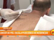 Trujillo: cáncer de piel escala posiciones en incidencias