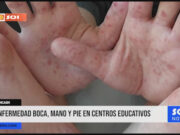 Áncash: enfermedad boca, mano y pie en centros educativos