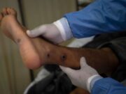 Nacional: Minsa emite alerta epidemiológica por nueva variante Mpox de la viruela del mono
