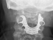 Huacho: adulto mayor traga dentadura postiza durante ataque de epilepsia