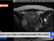 Nacional: cáncer de cuello uterino es la primera causa de muerte entre las mujeres