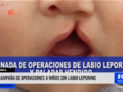Cajamarca: campaña de operaciones a niños con labio leporino