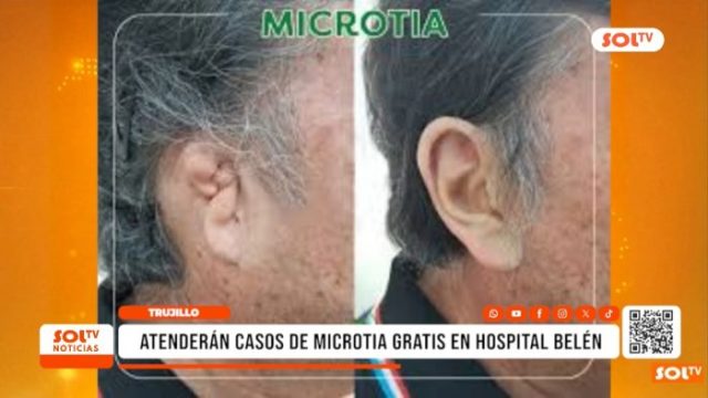 atenderan casos de microtía
