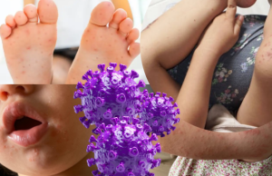 Lambayeque: virus mano pie boca supera 30 casos en niños