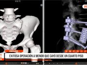 Chiclayo: exitosa operación a menor que cayó desde un cuarto piso