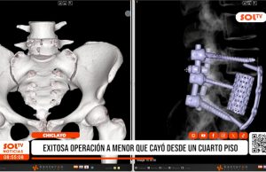 Chiclayo: exitosa operación a menor que cayó desde un cuarto piso