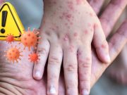 Nacional: declaran 90 días de emergencia sanitaria por sarampión