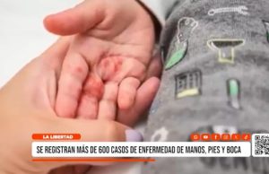 La Libertad: reportan más de 600 casos de Coxsackie